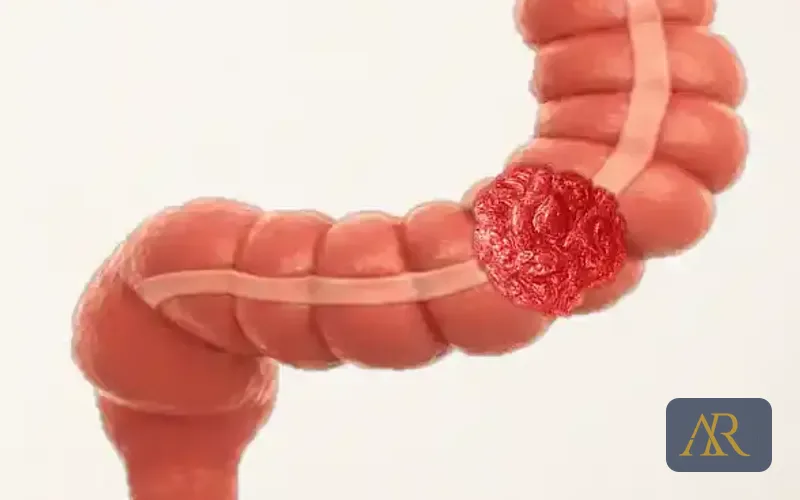 Câncer de Cólon e Reto